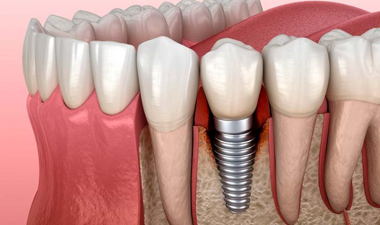 implant periodontitis